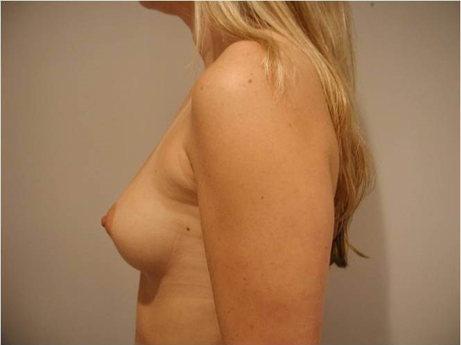 Breast Augmentation From A to C Cup — before, view 2