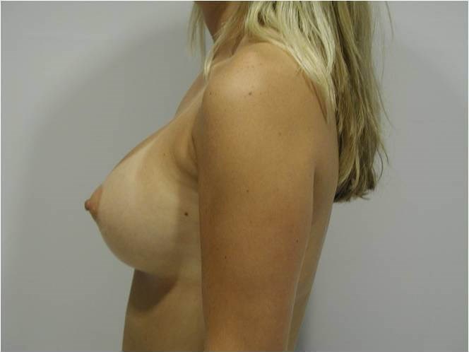 Breast Augmentation From A to C Cup — after, view 2