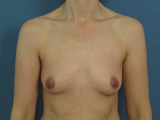Liposuction and Fat Transfer to the Breasts Going From an A to C Cup — before, view 2