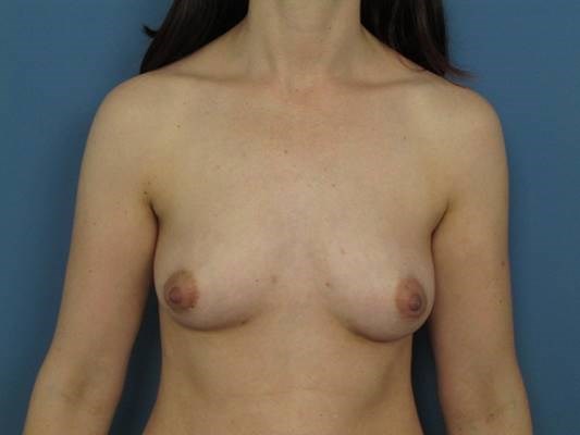 Liposuction and Fat Transfer to the Breasts Going From an A to C Cup — after, view 2