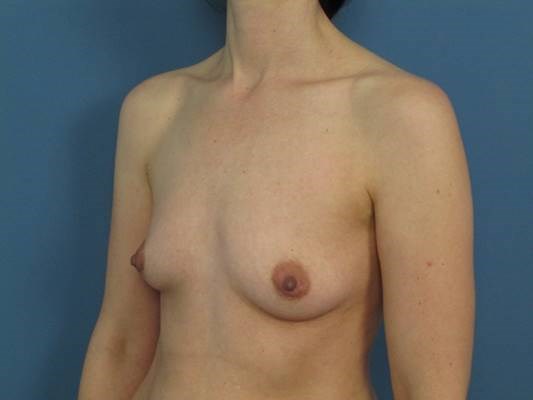 Liposuction and Fat Transfer to the Breasts Going From an A to C Cup — before, view 3
