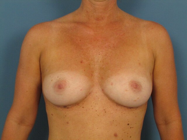 Fat Transfer to the Breasts with Liposuction of Back, Flanks, Abdomen and Thighs — after, view 2