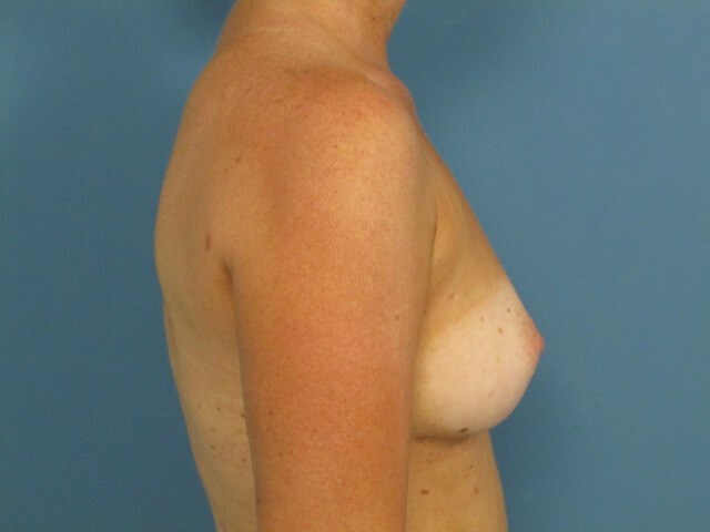 Fat Transfer to the Breasts with Liposuction of Back, Flanks, Abdomen and Thighs — after, view 3