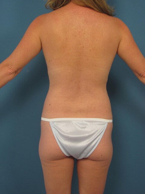 Fat Transfer to the Breasts with Liposuction of Back, Flanks, Abdomen and Thighs — before, view 4