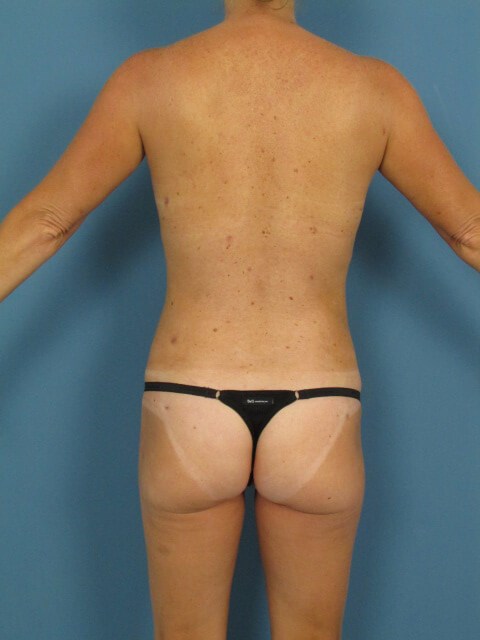Fat Transfer to the Breasts with Liposuction of Back, Flanks, Abdomen and Thighs — after, view 4
