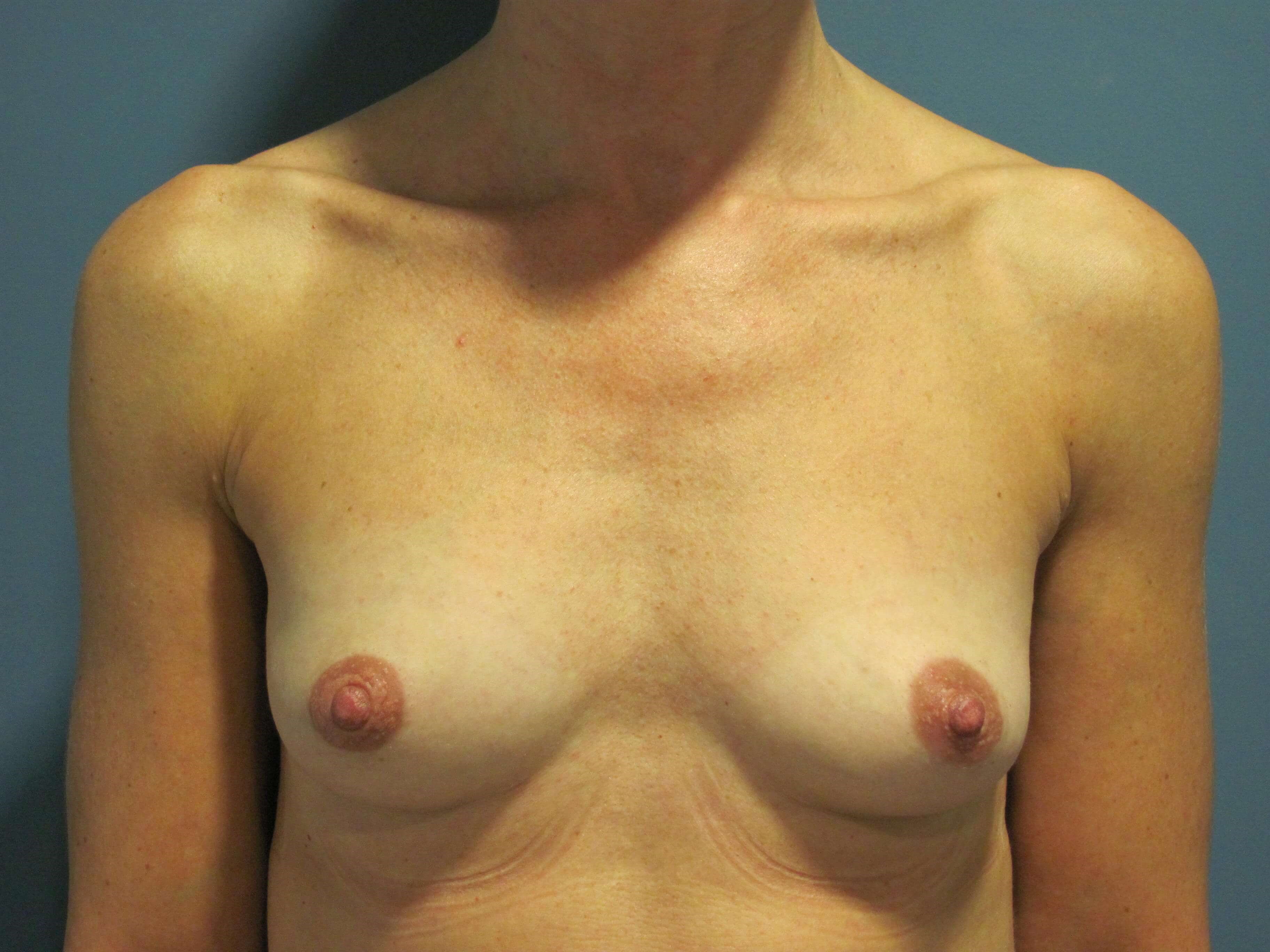 Fat Transfer to the Breasts