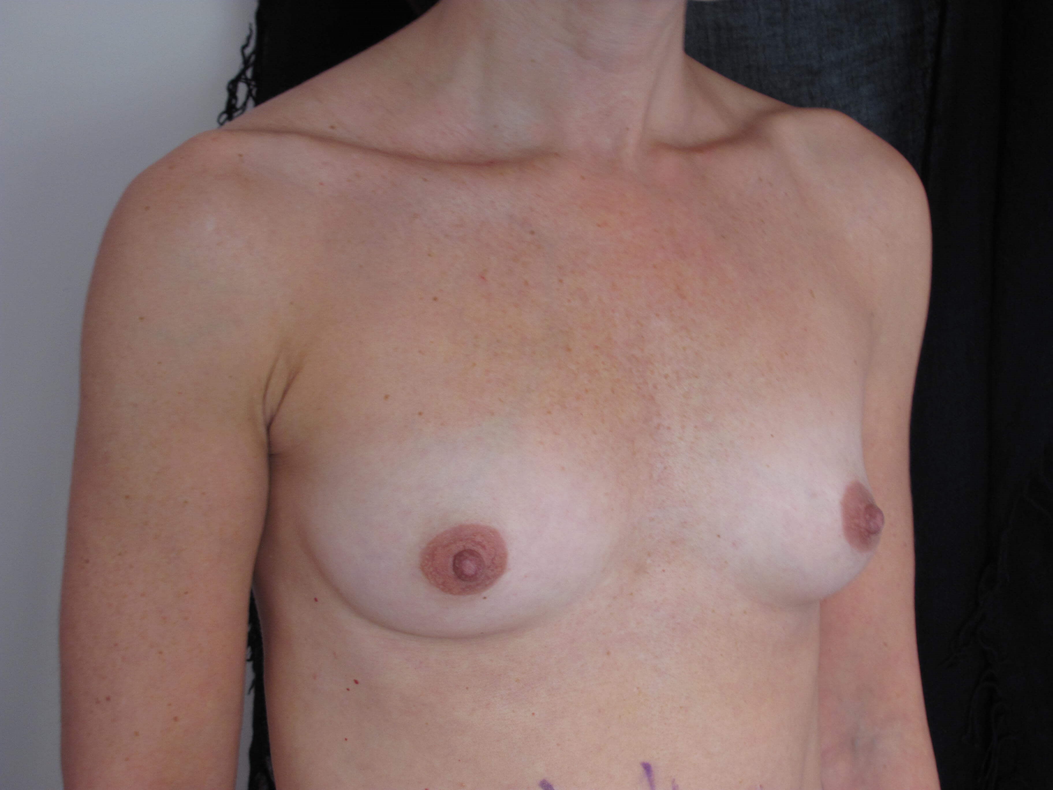 Fat Transfer to the Breasts — before, view 2