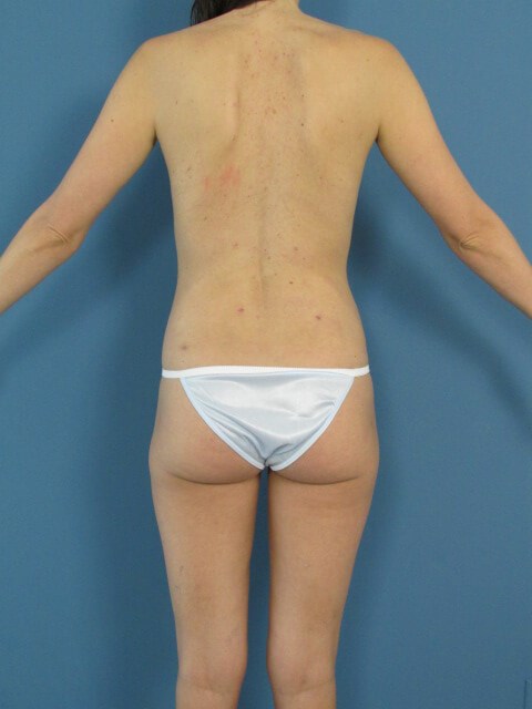 Removal of Breast Implants and Replacement with Fat — after, view 7