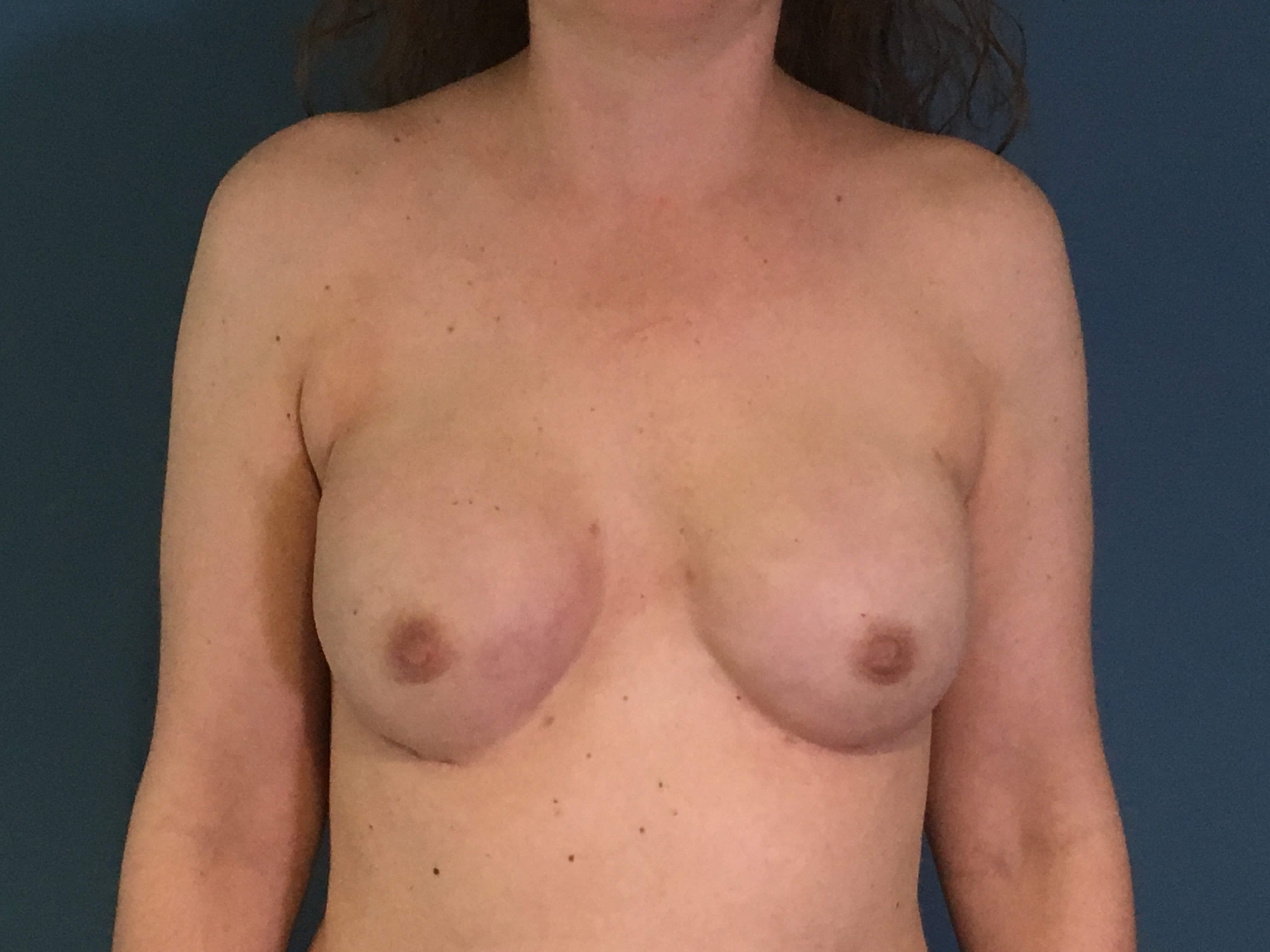 Bilateral Two Stage Breast Reconstruction for Cancer
