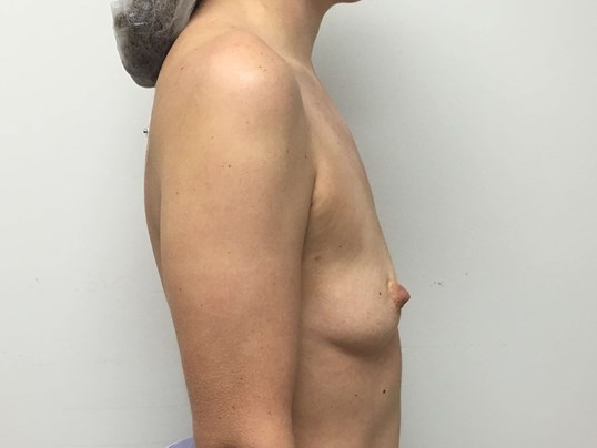 Bilateral Two Stage Breast Reconstruction for Cancer — before, view 3