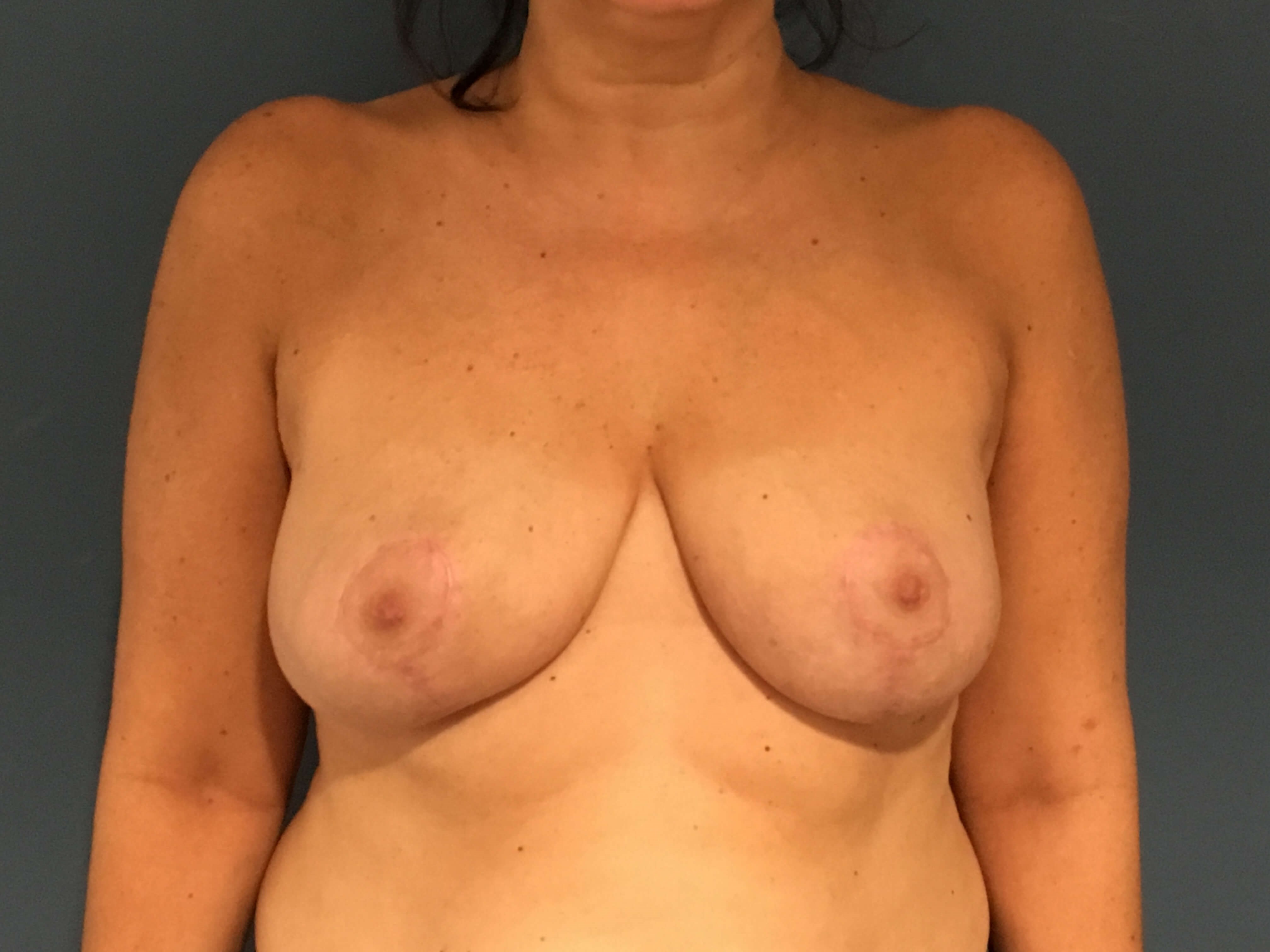Breast Reduction