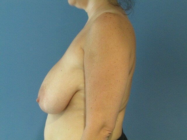 Breast Reduction — before, view 3