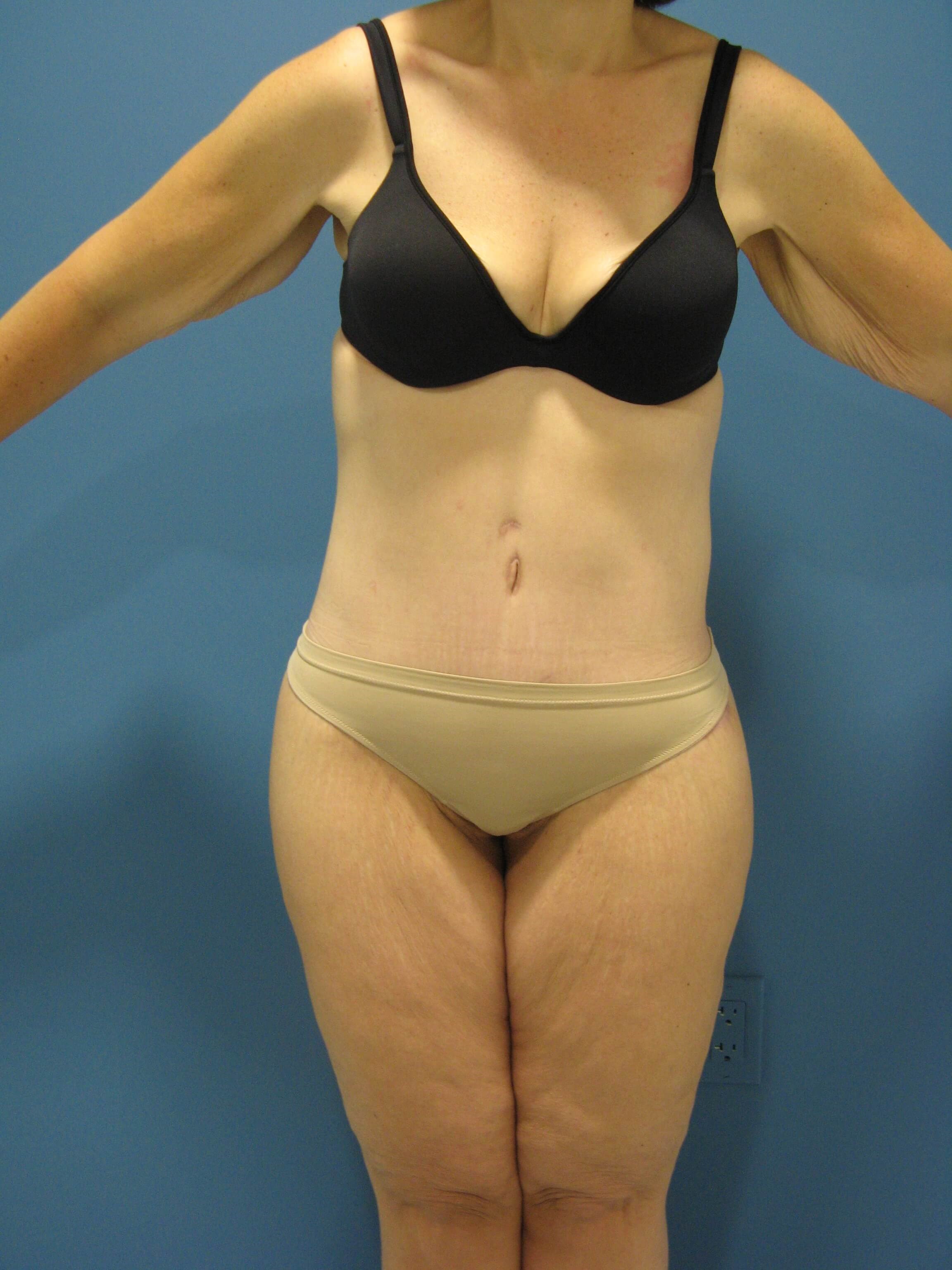 After Weight Loss Surgery