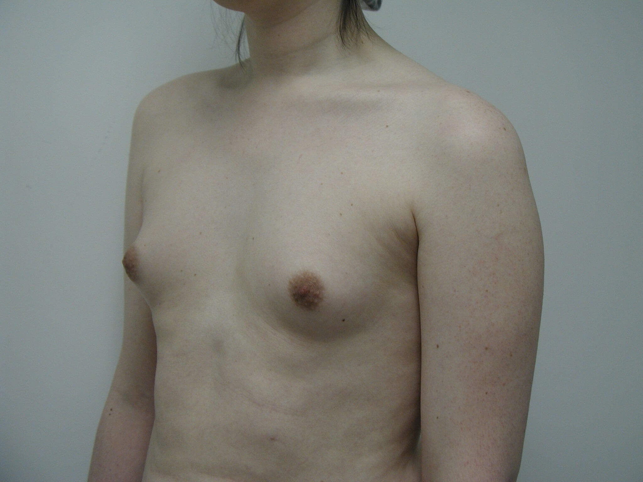 Transgender Male-to-Female Breast Augmentation — before, view 2