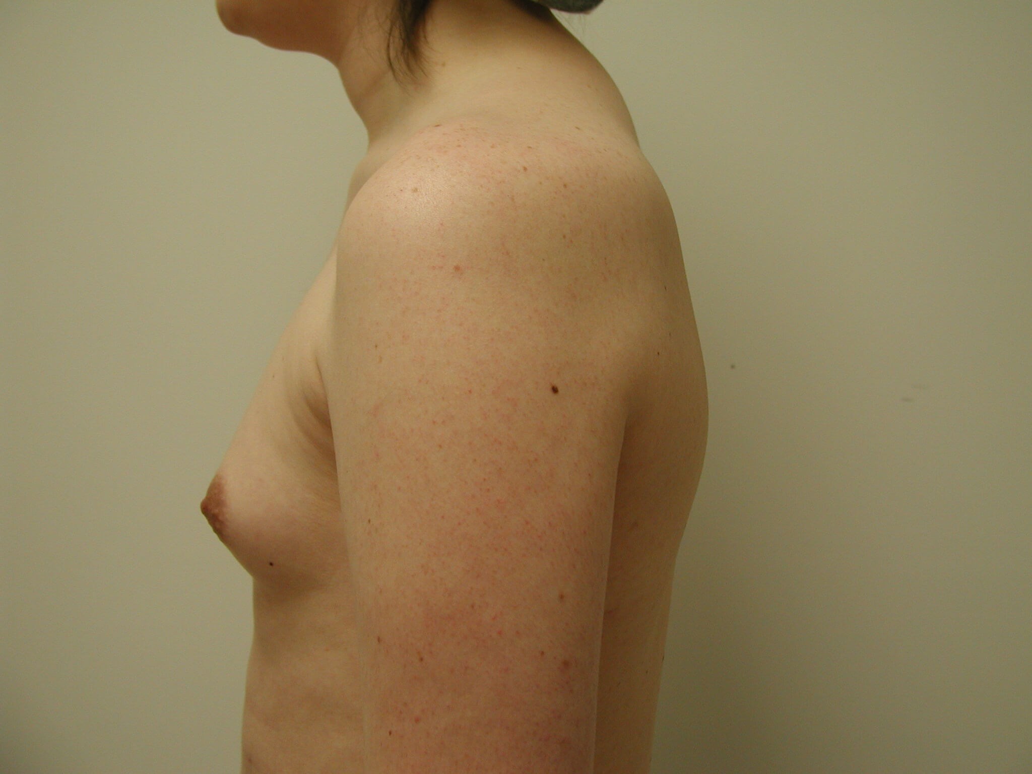 Transgender Male-to-Female Breast Augmentation — before, view 3