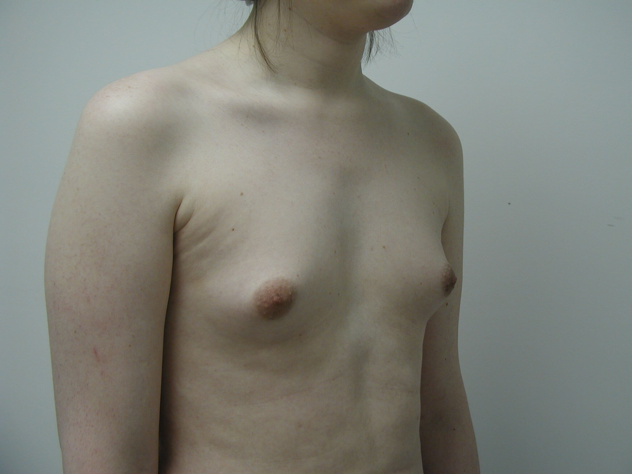 Transgender Male-to-Female Breast Augmentation — before, view 4