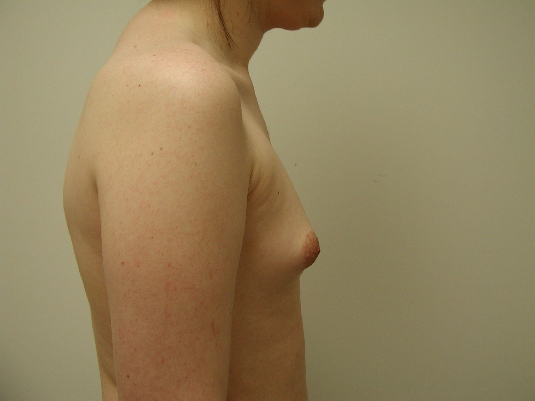 Transgender Male-to-Female Breast Augmentation — before, view 5