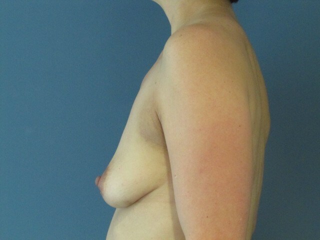 Two-Stage Bilateral Breast Reconstruction with Silicone Gel Implants — before, view 3