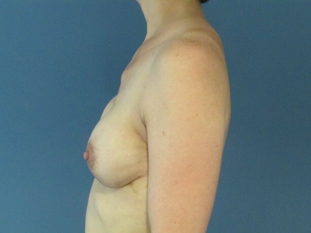 Two-Stage Bilateral Breast Reconstruction with Silicone Gel Implants — after, view 3