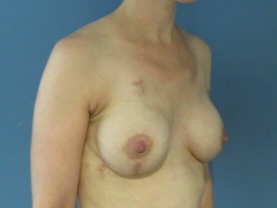 Two-Stage Bilateral Breast Reconstruction with Silicone Gel Implants — after, view 4