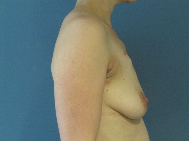 Two-Stage Bilateral Breast Reconstruction with Silicone Gel Implants — before, view 5