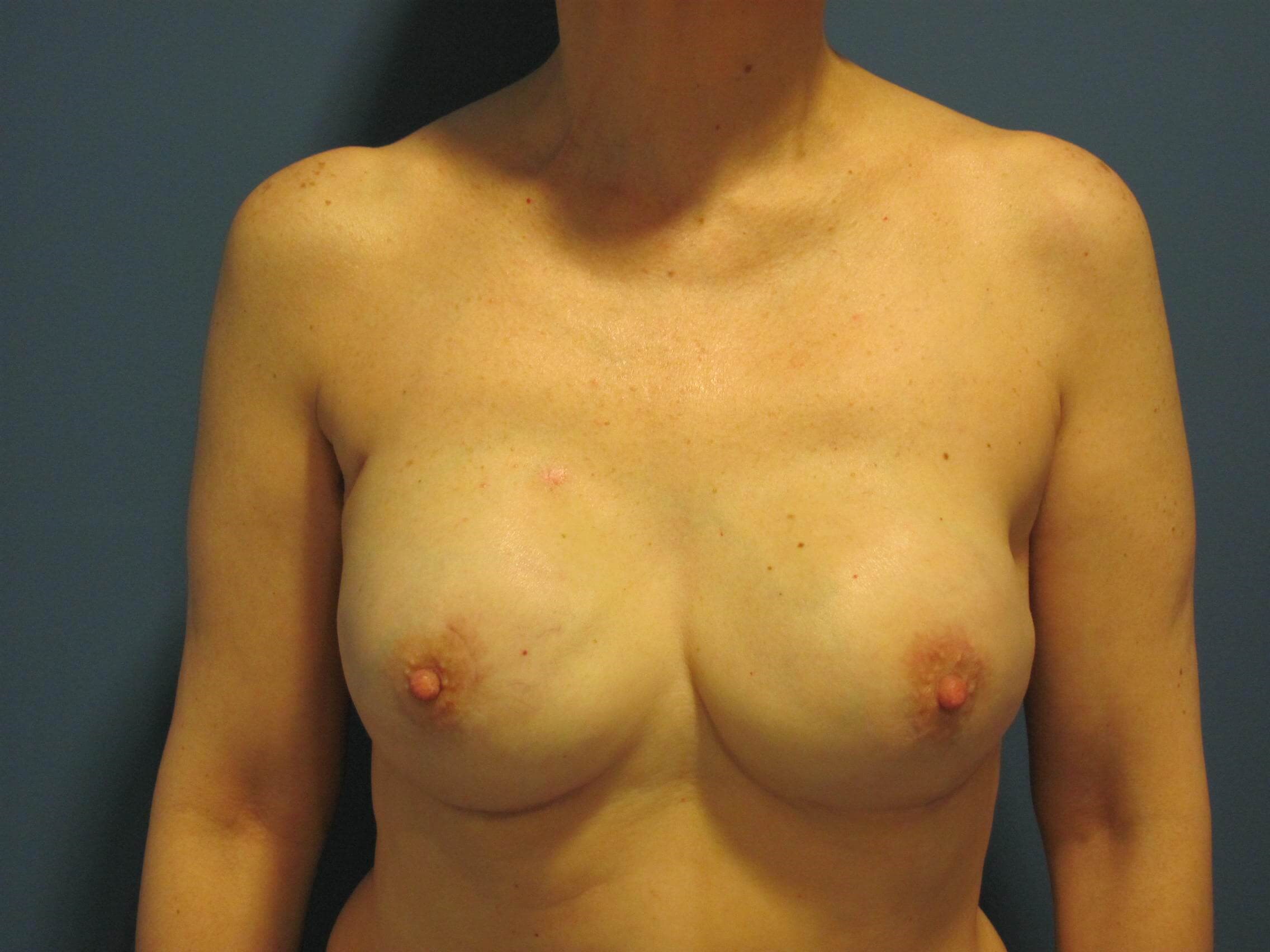 Bilateral Two-Stage Breast Reconstruction with Tissue Expanders and Implants