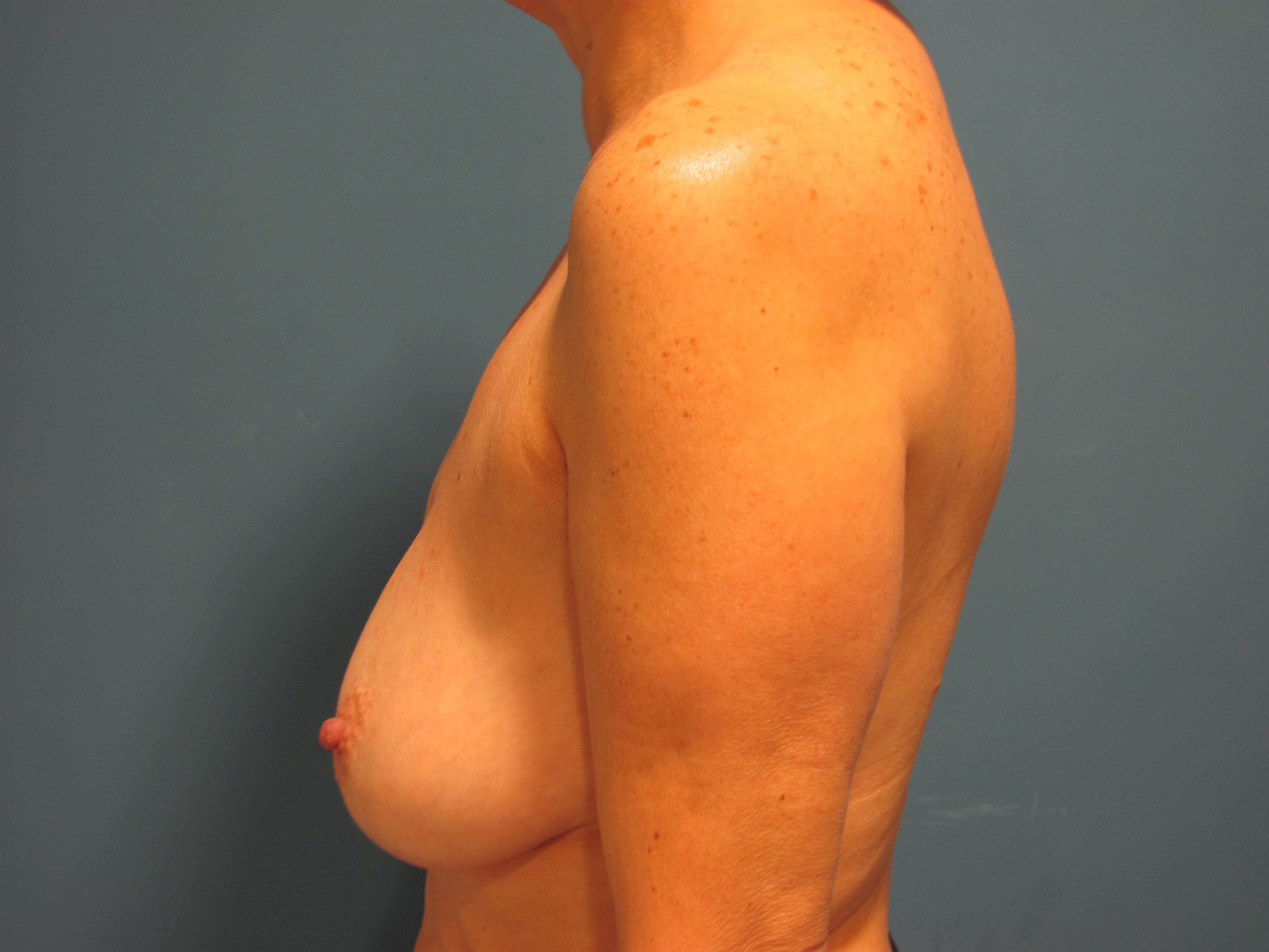 Bilateral Two-Stage Breast Reconstruction with Tissue Expanders and Implants — before, view 3