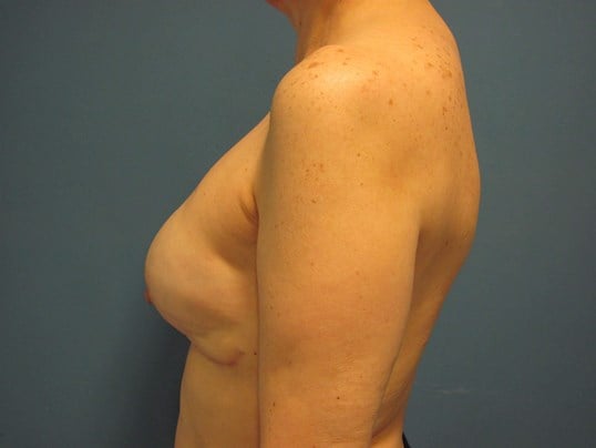 Bilateral Two-Stage Breast Reconstruction with Tissue Expanders and Implants — after, view 3