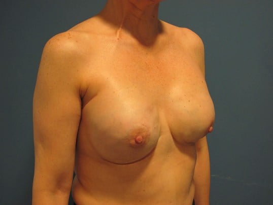 Bilateral Two-Stage Breast Reconstruction with Tissue Expanders and Implants — after, view 4