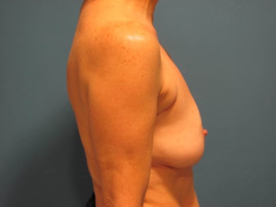 Bilateral Two-Stage Breast Reconstruction with Tissue Expanders and Implants — before, view 5
