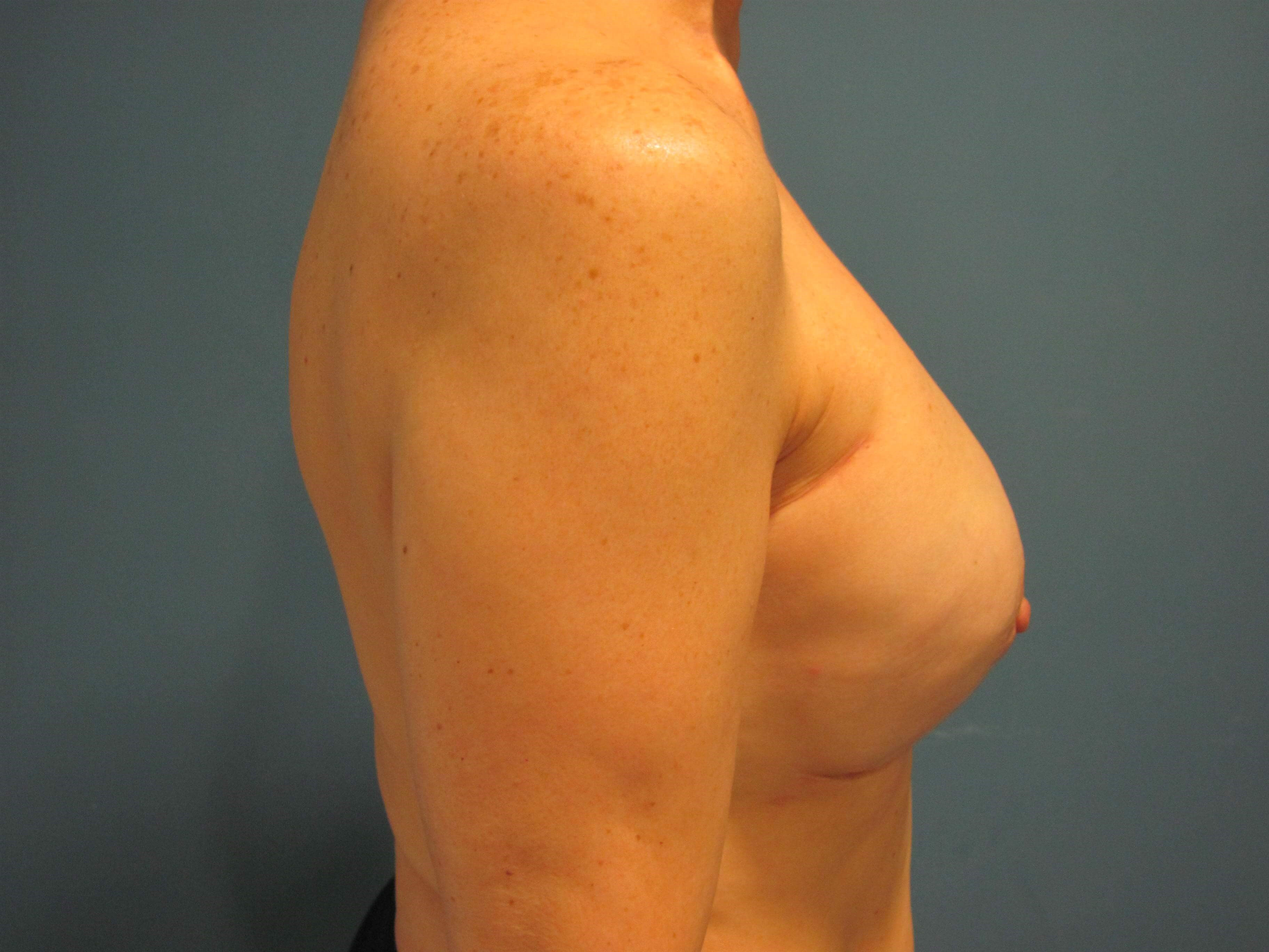 Bilateral Two-Stage Breast Reconstruction with Tissue Expanders and Implants — after, view 5