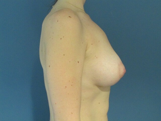 Tuberous Breast Reconstruction with Bilateral Implants, Lift and Fat Grafting. — after, view 5