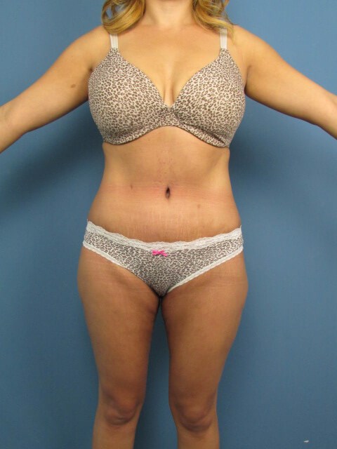Tummy Tuck, Liposuction of Flanks, Back and Thighs and Medial Thigh Lift