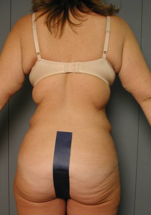Circumferential Body Lift, Arm Lifts and Breast Lifts After Weight Loss. — before, view 3