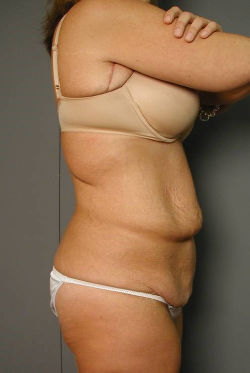 Circumferential Body Lift, Arm Lifts and Breast Lifts After Weight Loss. — after, view 2