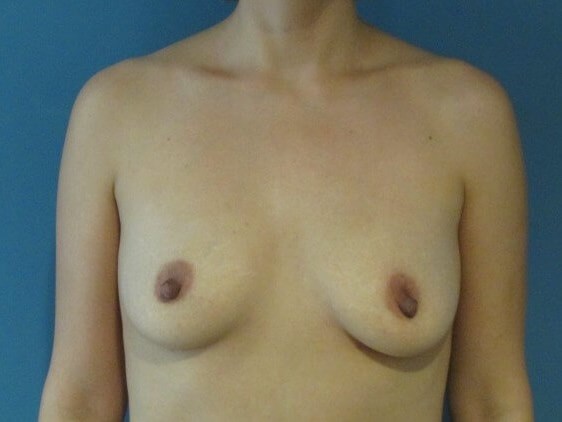 Autologous Fat Transfer to the Breasts