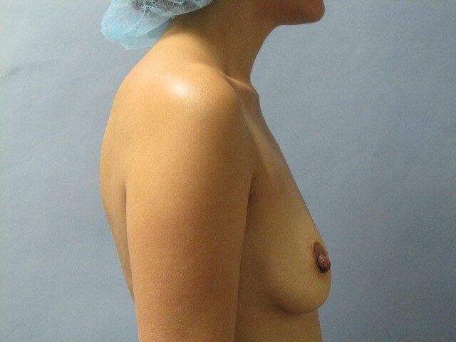 Autologous Fat Transfer to the Breasts — before, view 3