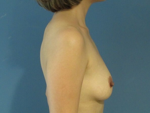 Autologous Fat Transfer to the Breasts — after, view 3