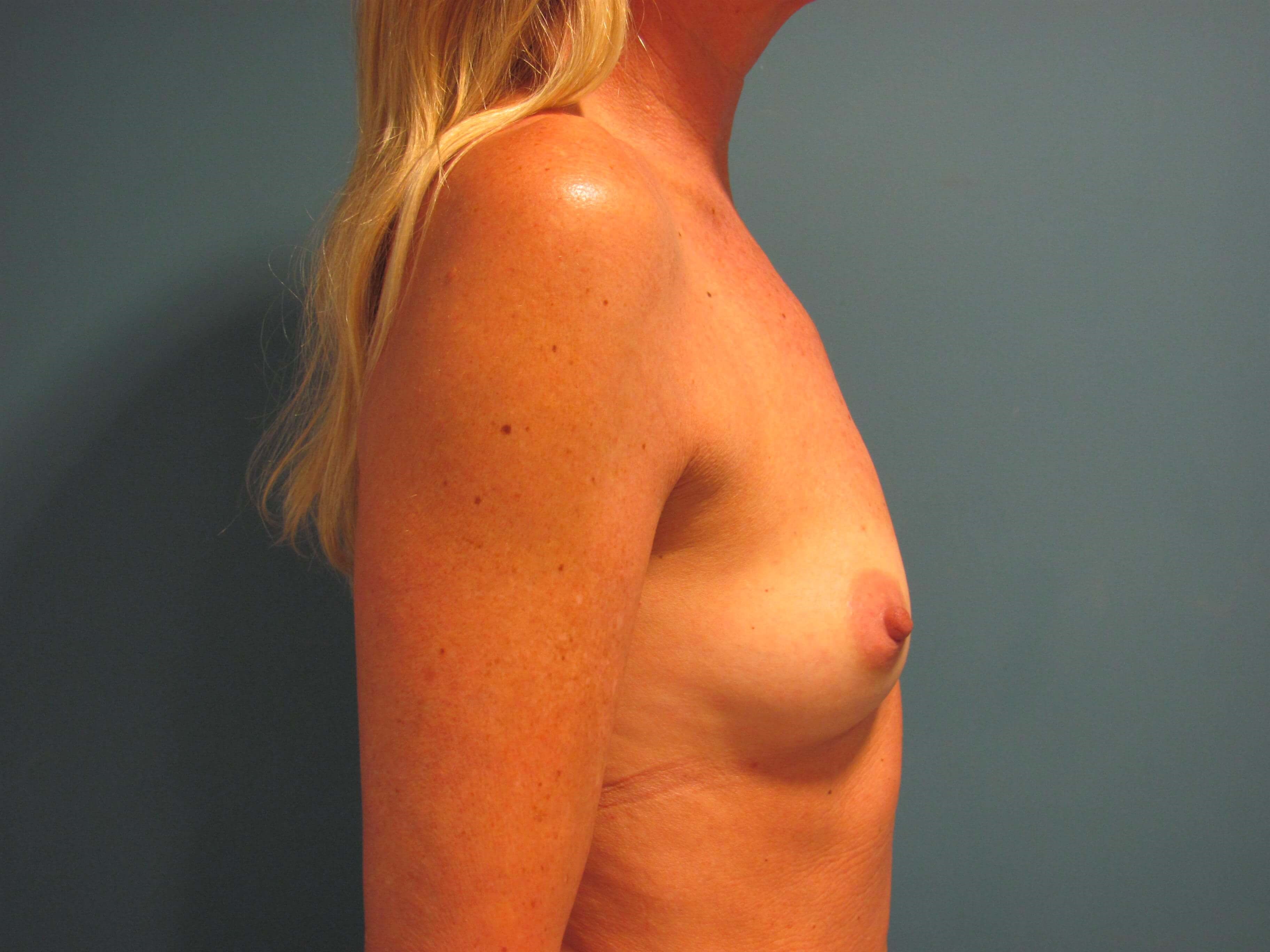 Bilateral Breast Augmentation with 304 Cc Round Smooth Silicone Gel Implants — before, view 3