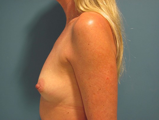 Bilateral Breast Augmentation with 304 Cc Round Smooth Silicone Gel Implants — before, view 5