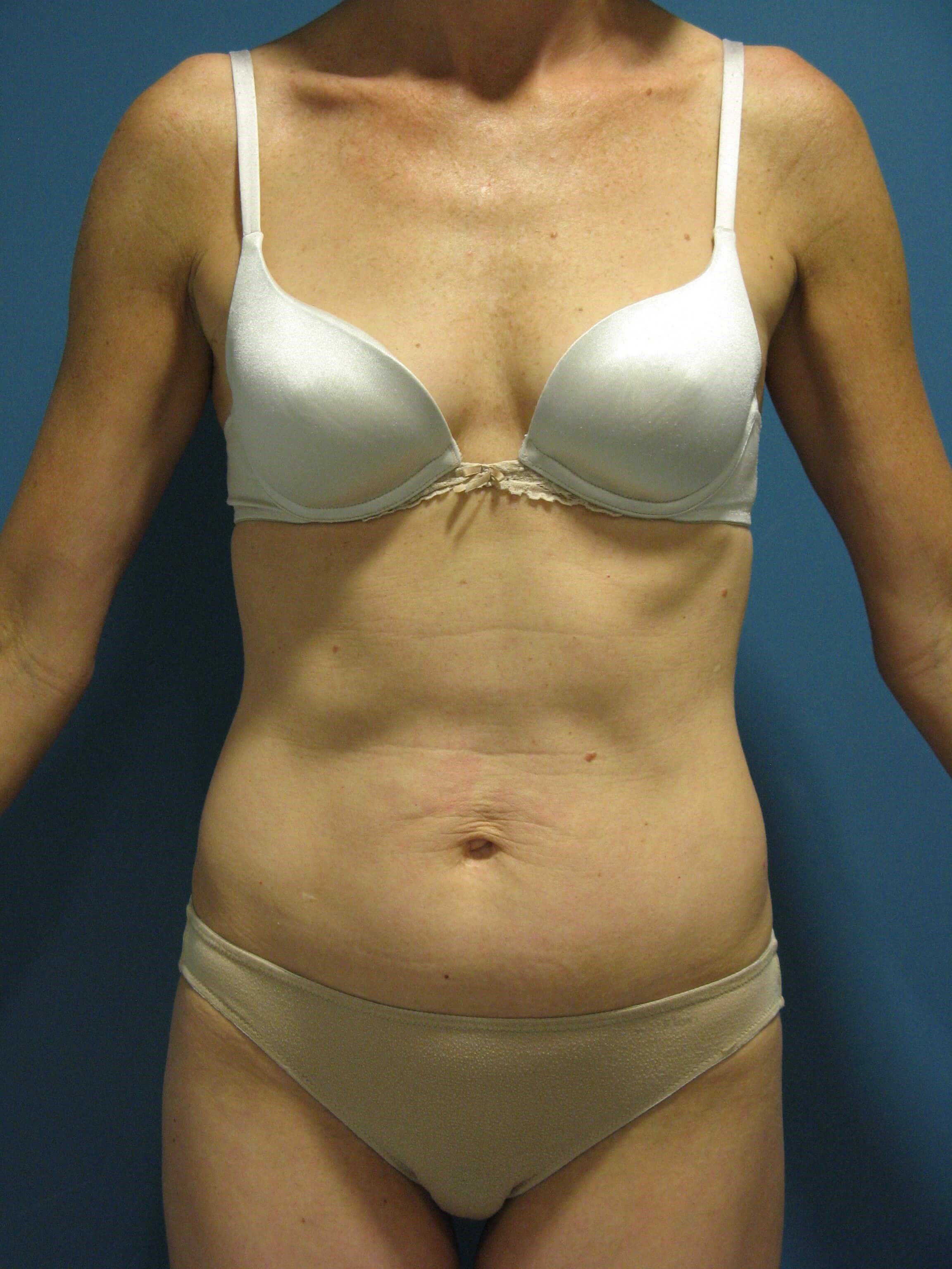 Mommy Makeover with Abdominoplasty and Breast Augmentation in a 40-Year-Old Woman, before, view 1