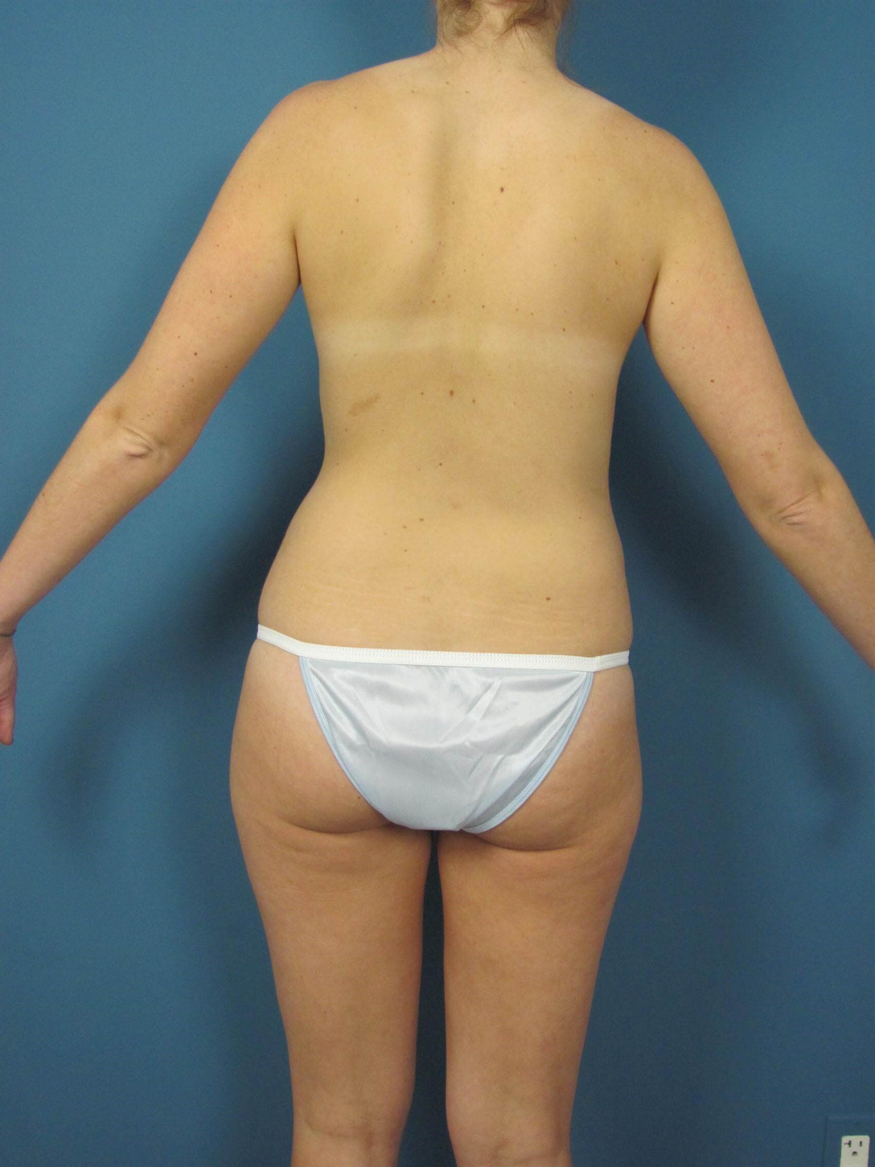 Full Body Liposuction and Fat Transfer to Breasts in a 28 Year-Old Woman — before, view 3