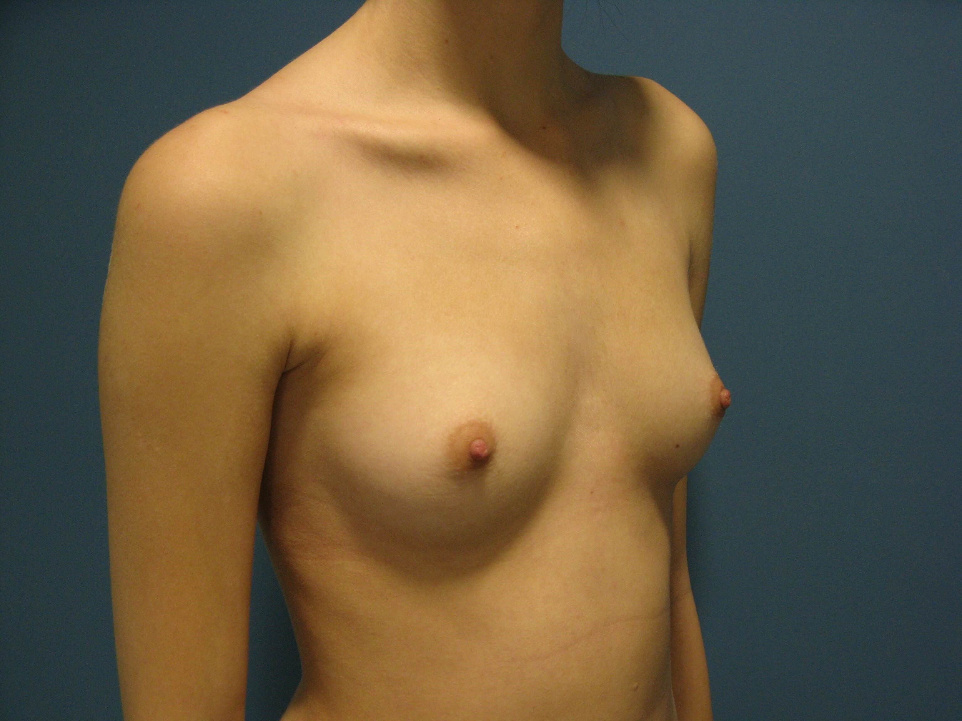 Bilateral Breast Augmentation with Silicone Implants in a 23 Year-Old A to C Cup — before, view 3
