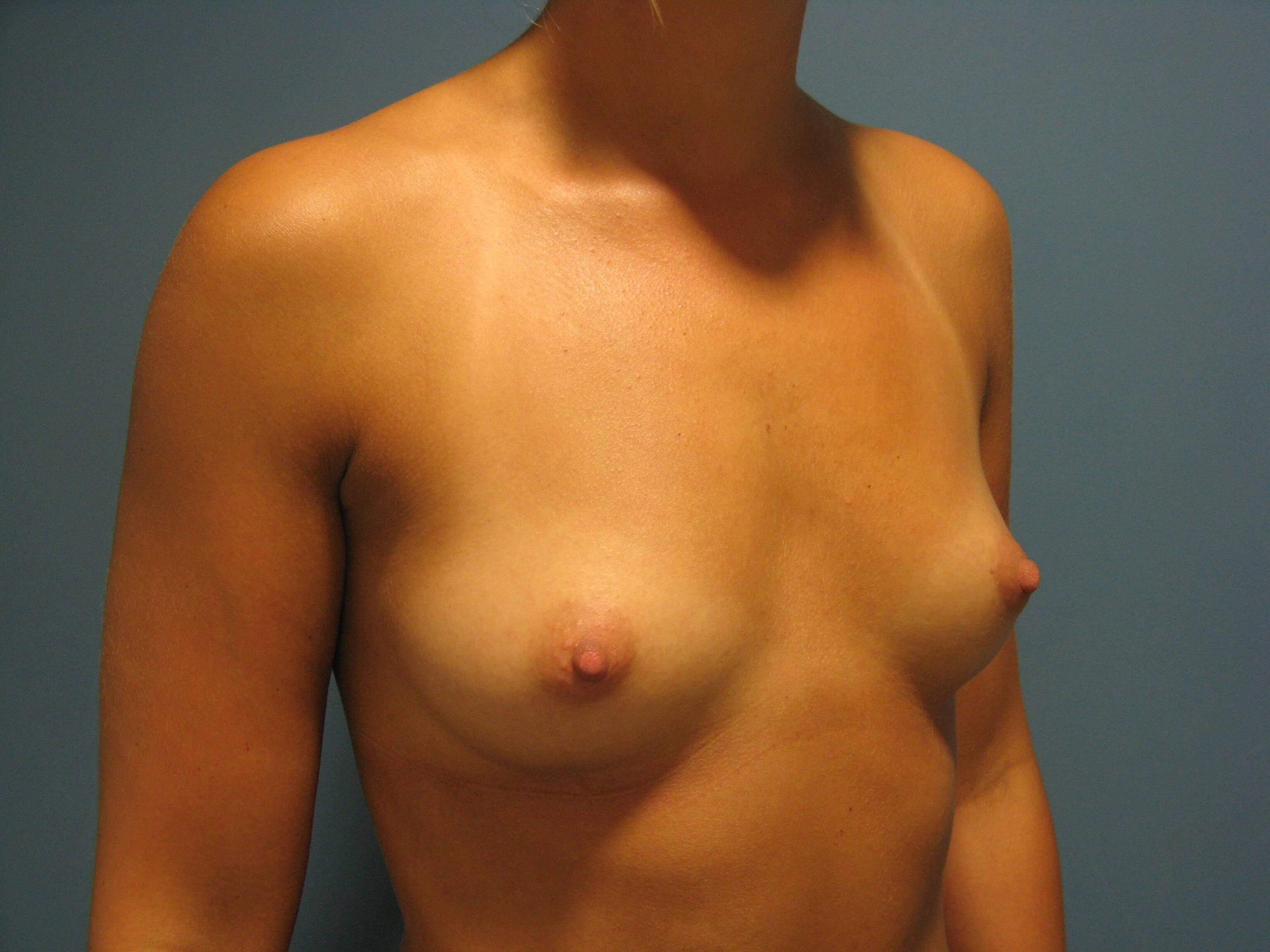 Twenty-Nine Year-Old Breast Augmentation A to C Cup — before, view 2