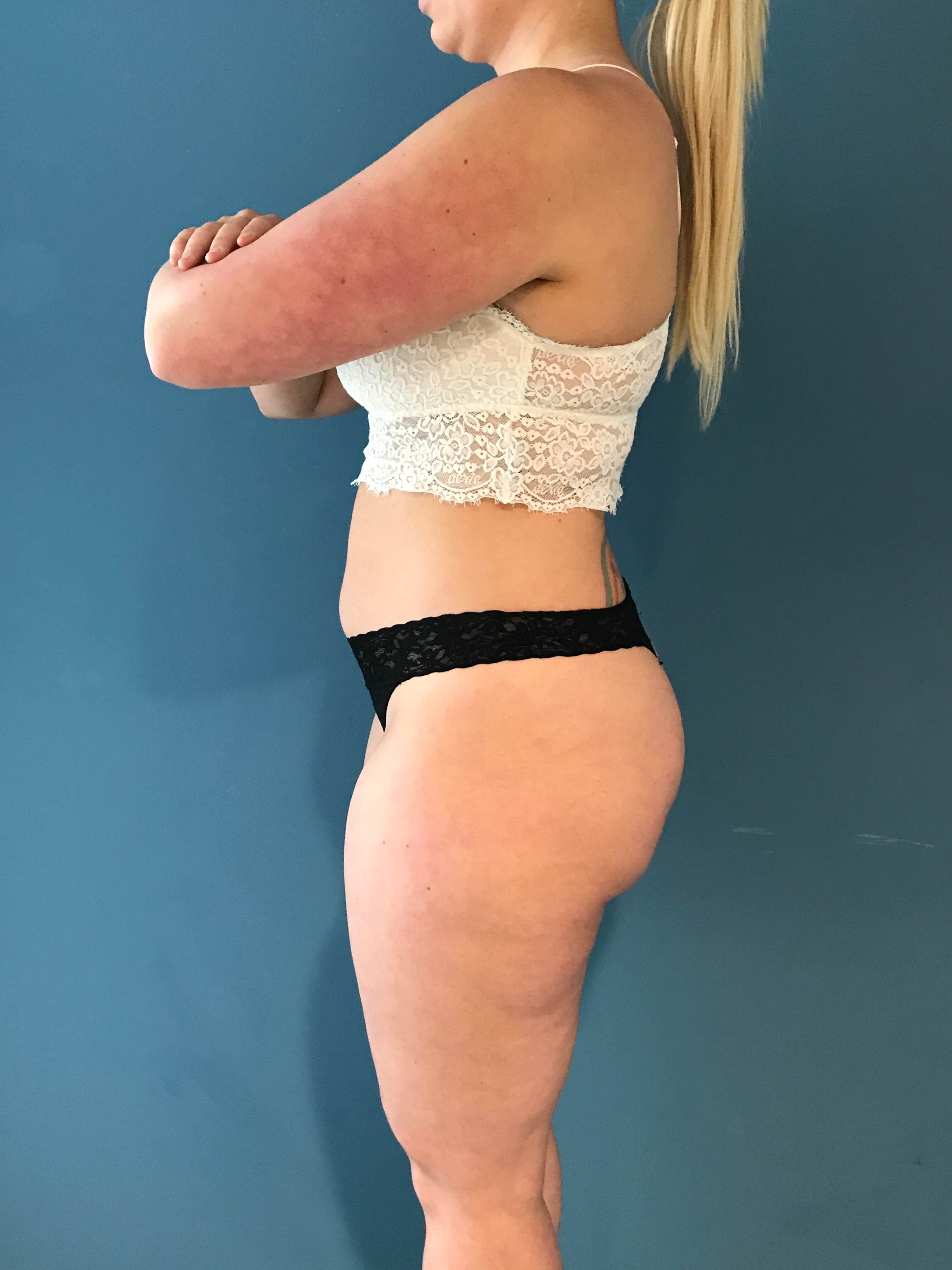 Full Body Contouring with Liposuction on a Thirty Year-Old Woman — before, view 3