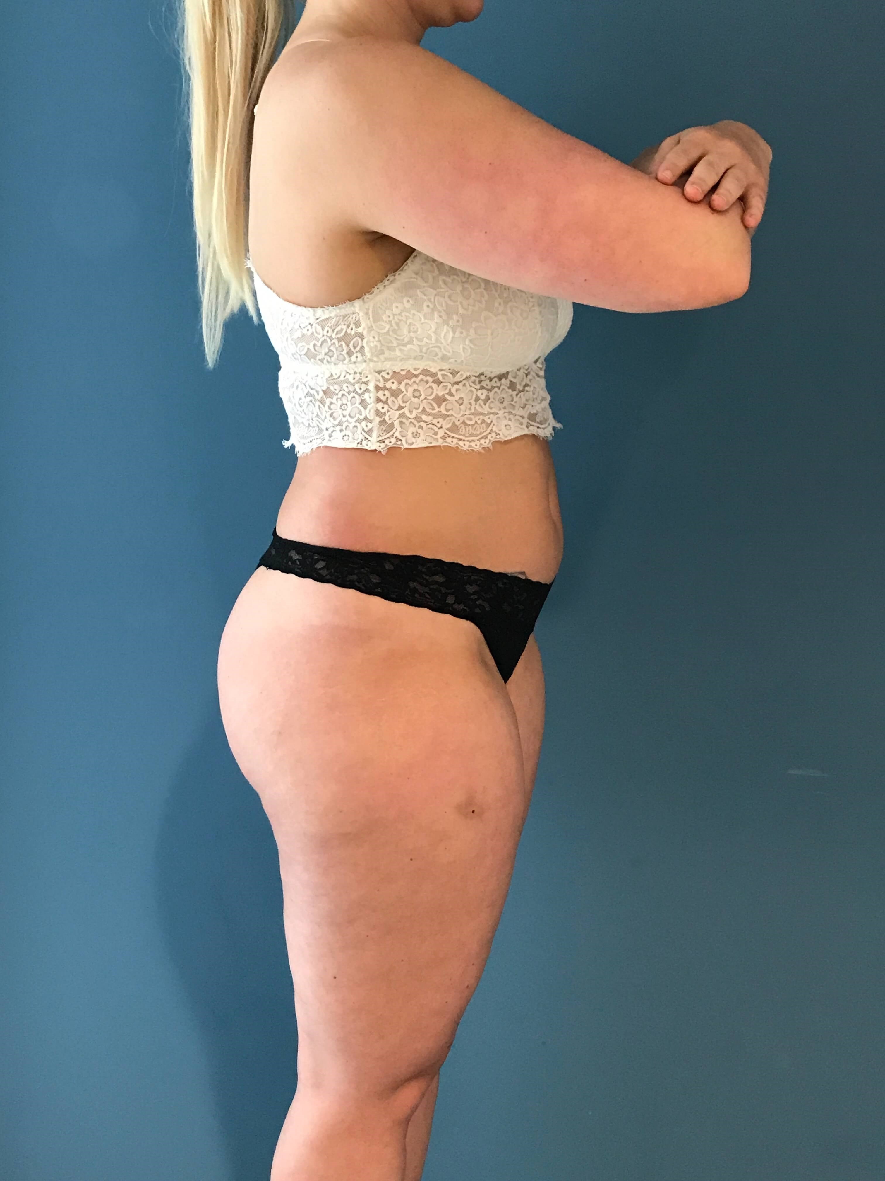 Full Body Contouring with Liposuction on a Thirty Year-Old Woman — before, view 4