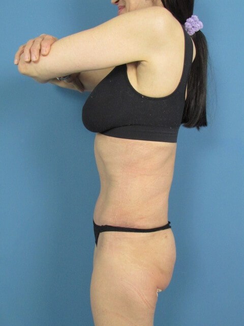 Full Abdominoplasty on a 56 Year-Old Woman for Core Strength and Back Pain