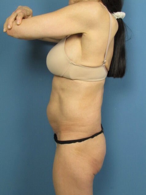Full Abdominoplasty on a 56 Year-Old Woman for Core Strength and Back Pain — before, view 2