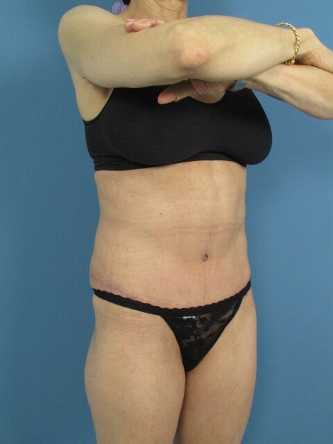 Full Abdominoplasty on a 56 Year-Old Woman for Core Strength and Back Pain — after, view 3