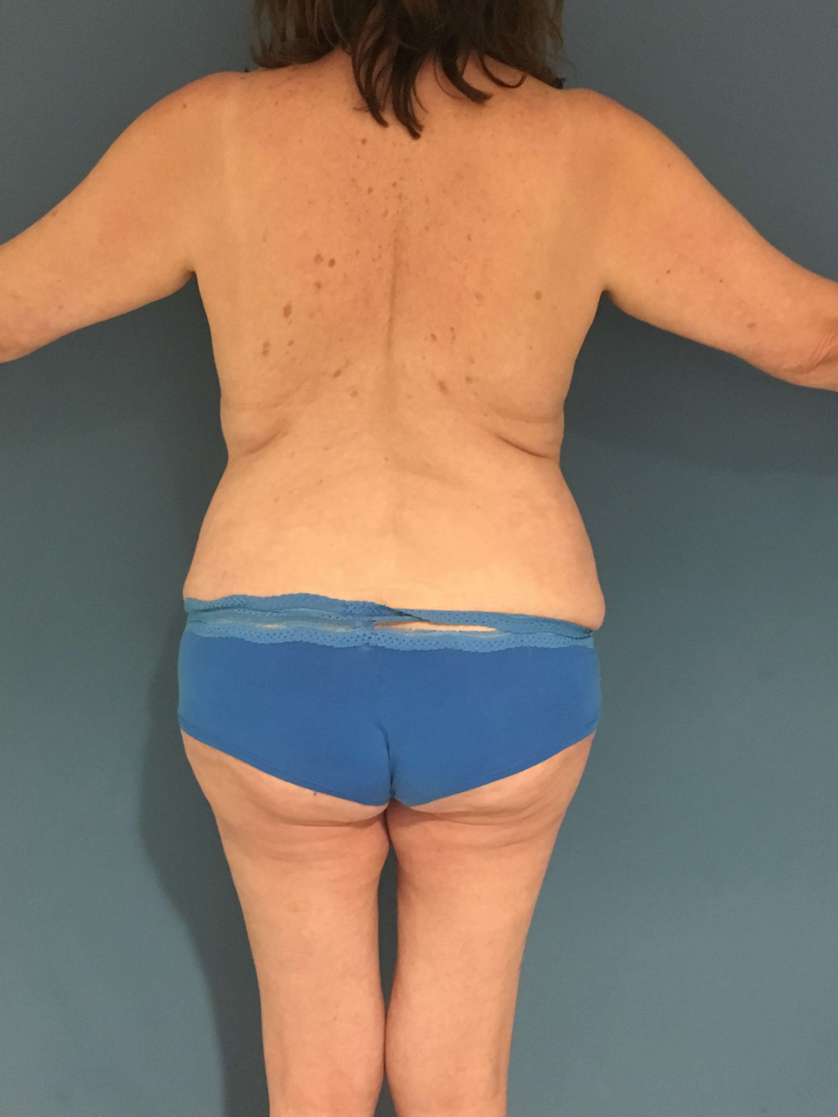 Menopause Makeover with Removal of Bilateral Breast Implants and Fat Transfer — after, view 2